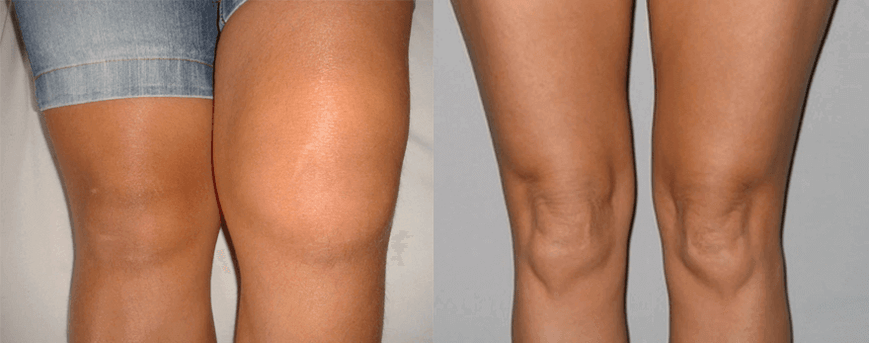 Tapasztalatok a Cannabis Oil kapszulák használat előtt és után Eva-tól